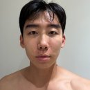 팔자주름 필러 대신 힐로웨이브 내돈내산 후기, 반포 피부과