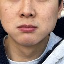 진해서울약국 | 압구정 루나의원 루비레이저 982방 맞은 후기(직후~3주차 후기)