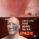 스테로이드 많은 기적의 크림, 자주 쓰면 피부가‥ 이미지