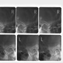 측두하악관절 방사선촬영술[Temporomandibular joint radiography] 이미지