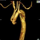 Aortic arch replacement with prophylactic aortic arch debranching during type A acute aortic dissection repair: initial experience with 23 patients 이미지