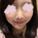 [내돈내산] 강남 라렌의원 슈링크유니버스 후기 / 이중턱 슈링크 시술했어요