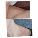 유닛뷰티 | 여름맞이 승모근관리 창원 승모근보톡스 코어톡스 200유닛 3회차 후기!