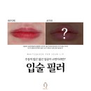 화이트퀸의원 | 대구 입술필러 맞춤형 디자인 컨설팅 후기