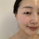 보떼춘천 | [춘천 피부관리/필링과 재생을 동시에, 광채필링 후기] 춘천 피부관리 르보떼Face PT (전)르보떼에스테틱