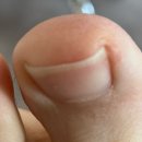 세상편한발톱 | 광양 중마동 세상편한발톱 내성발톱 교정 후기 (문제성 발톱) +한달 후 변화