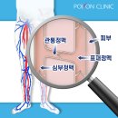 다리혈관에 문제가 생기면 어떻게 될까요? 이미지