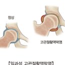 성인소아 일과성 고관절활액막염이란 이미지