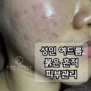 이일연구소 | 성인 여드름 붉은 자국 진정 피부관리 케이속건조피부연구소