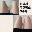 허벅지 무한람스 3주차 -2cm 줄어든 후기 비용 및 후관리 종류 비포앤애프터는