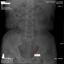 수일전부터 좌측 아랫배가 통증이 있어 응급실을 2차례 방문한 56세 남자환자 이미지