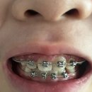 악궁확장장치 비용 초4 양부대 어린이치과 다녀요