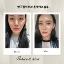 블루 | 피부탄력UP ! 압구정피부과 에이든의원 튠페이스블루 솔직 후기