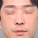 엘리트성형외과의원 | 남자도 기미 생긴다? 마크뷰로 확인한 진짜 결과(스타워커 치료후기)