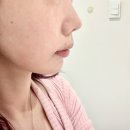 강남역 피부과 온다리프팅 10일차 후기 팔자 입가처짐 턱라인 리얼후기