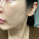 (주)대신환경 | 부산 서면 피부과 ECM 콜라겐 스킨부스터 리투오 대신 셀르디엠 큐어젯으로 시술한 후기
