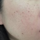 미드림성형외과의원 | 동탄 수원 비립종제거 점제거 미드림성형외과 리얼후기 내돈내산