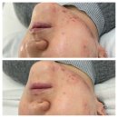 한국메디컬 의정부지사 | 인천 트러블관리 태나뷰티 여드름관리 받고온 후기