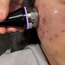 자유한의원 | 천안 여드름 치료 4회차 피부 고민에 맞춘 리젠 부스터 천안 여드름 전문 한의원 후기