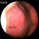 만성비염, 후비루증후군 증상 1달만에 개선된 치료 후기