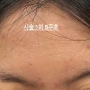 해율한의원 | 미간 흉터 치료 추천_해율 한의원 강남 3차 후기