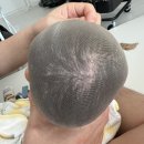 늘기쁨의료기 | 사두증 교정 최종 후기, 4개월 간의 길었던 여정의 끝