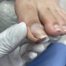 내성발톱이 고민이라면 구로네일샵 푸스케어 구로항동점