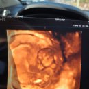 한빛병원 | 한빛여성병원 니프티검사 후기