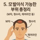 모발이식 가능한 부위 총정리 (M자, 정수리, 헤어라인 등)