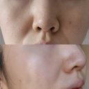 샤인성형외과 | 신사역 스킨부스터 오아시스부스터 손주사 신상 성형외과 솔직후기