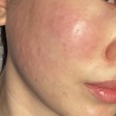 뉴라인 | 부산쥬베룩부스터 뉴라인성형외과의원 마취크림 후기(수면마취 가능)