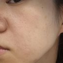 세상의모든아름다움의원 | 얼굴 점, 사마귀 제거 후기 (망포 세모아 의원 재방문)