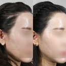 참편한하신경과의원 | (1년 경과) 망한 1차 수술, 모우림에서 대만족하게 되는 과정! feat.수술 직후의 불규칙성이 어떻게...