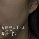 우인빌딩 | [ 강남 편평사마귀] 흉터 없이 편평사마귀치료 받기 _ 시술당일부터 2주차까지