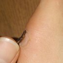 20대 여대생 사마귀 퇴치 후기 (혐짤주의)/ 사마귀 냉동치료
