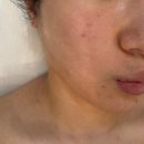 화중화에스테틱 | 중랑구에스테틱 연에스테틱 예민건조 피부 밝아진후기
