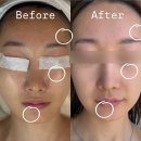 하단2동-5 | 하단 어스제이 스킨클리닉 여드름 트러블 피부 압출 필링 관리 후기