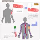 폼페 병(Pompe Disease[GSD II]) 이미지