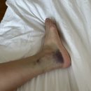 발목 인대 수술상담 및 예약(멍사진 주의!!) - 세종스포츠정형외과/청담리온정형외과