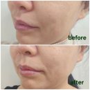 ㈜바른환경 | 올인원 주름 케어 크림 바이오힐보프로바이오덤3D 리프팅L-PDRN 크림 주름개선 크림 추천