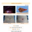 담낭용종수술후기. 건강검진 결과 담낭에 1.24cm 크기의 용종을 알게 되었고 수술 권유를 받게 되었습니다. 이미지