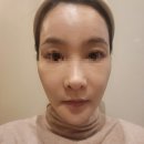 리즈멍 | 부산 서면역피부과 스킨부스터 리즈네 2주후기(멍, 부기, 효과, 가격)