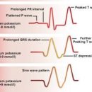 심전도검사 이상 소견 검사방법과 목적 이미지