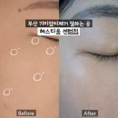 해운대 기미잡티제거 헤스티움 센텀점 멜라쓱싹 시술 후기