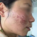 주식회사 이브이에스아그로 | [esV10] 여드름 피부 종류와 관리