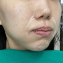 또팔자 | 신논현 피부과 올리디아 365 팔자주름 시술 후기