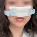 우리대학약국 | 30대 비염인,, 대학병원 비중격만곡증 수술후기