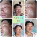 은하 인셀덤 | 광주인셀덤 피부주름 개선 노화방지 사용후기