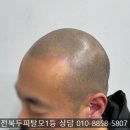 3018 | 대전두피페인팅 SMP 망치지 않는 3가지 방법