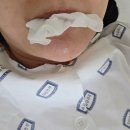 다빈치로봇수술 후기 2편과 부천성모 식단
